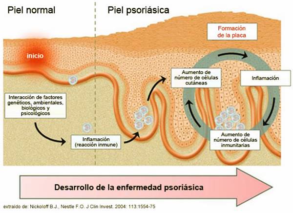 Causas de la psoriasis