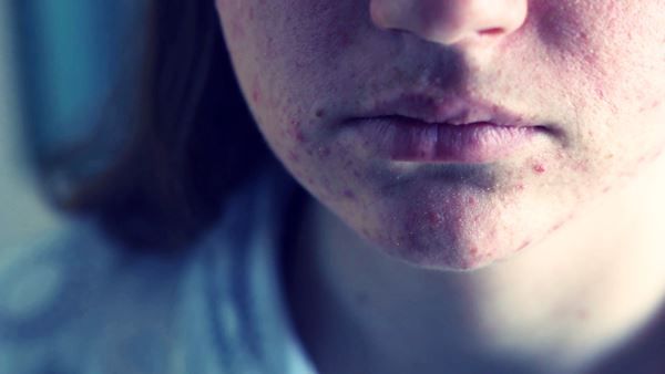 Síntomas del acné | Dermatólogo especialista en Madrid