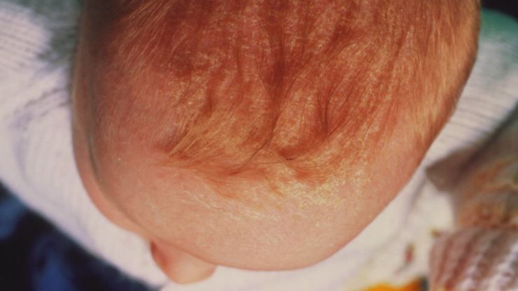 Dermatitis seborreica bebé