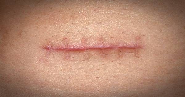 Dermatólogo especialista en cicatrices en Madrid