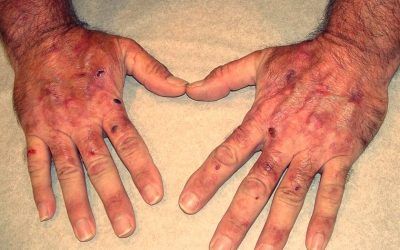 Porfirias: cómo daña la luz e importancia de protegerse de ella