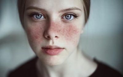 5 preguntas frecuentes sobre el lupus