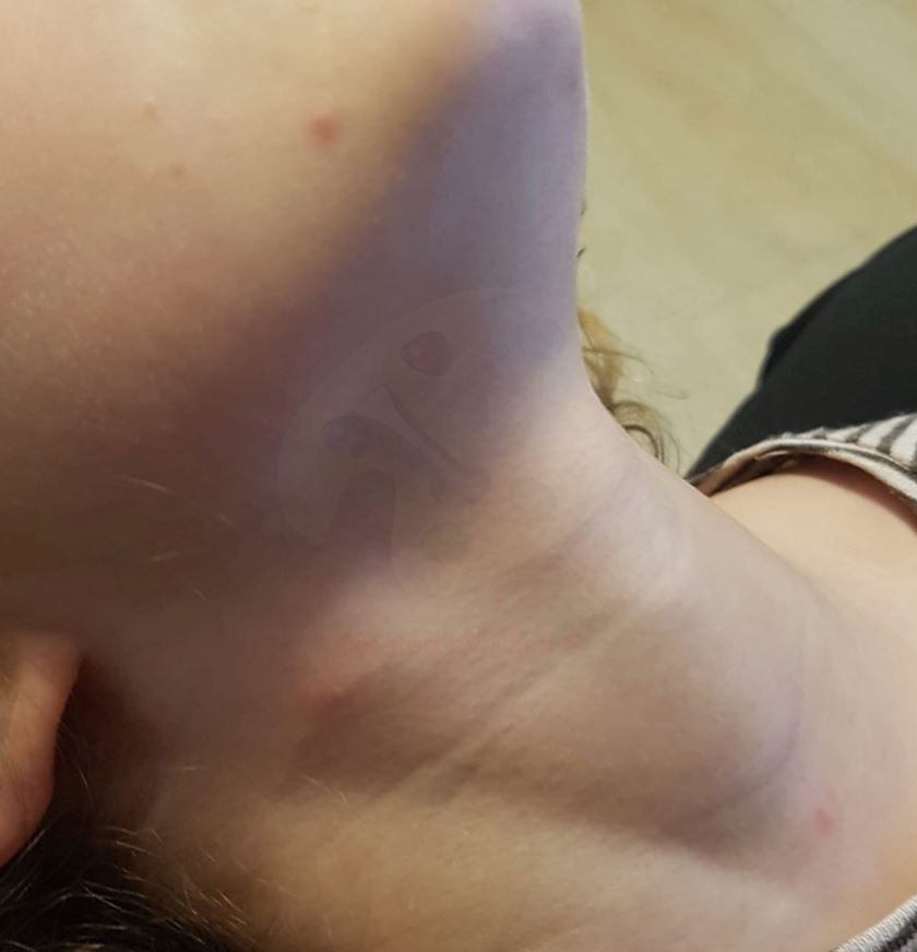Lesiones vesiculares en el cuello