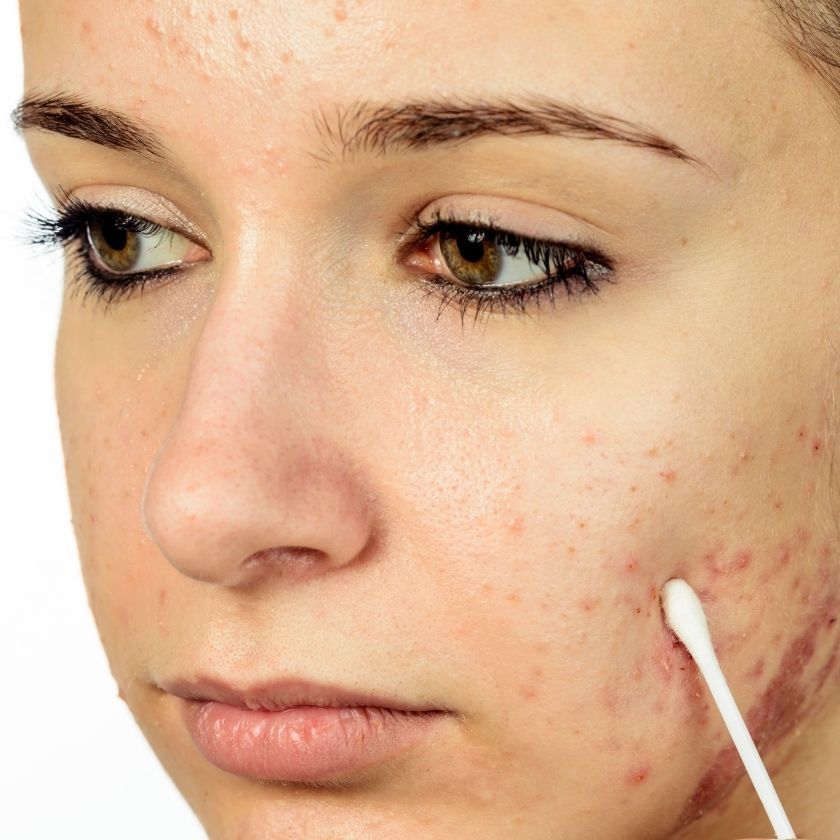 Isotretinoína en dosis bajas en el tratamiento del acné