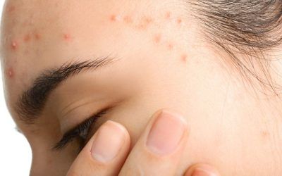 Isotretinoina a dosis bajas en el tratamiento del acné: low doses, slow mode and good results