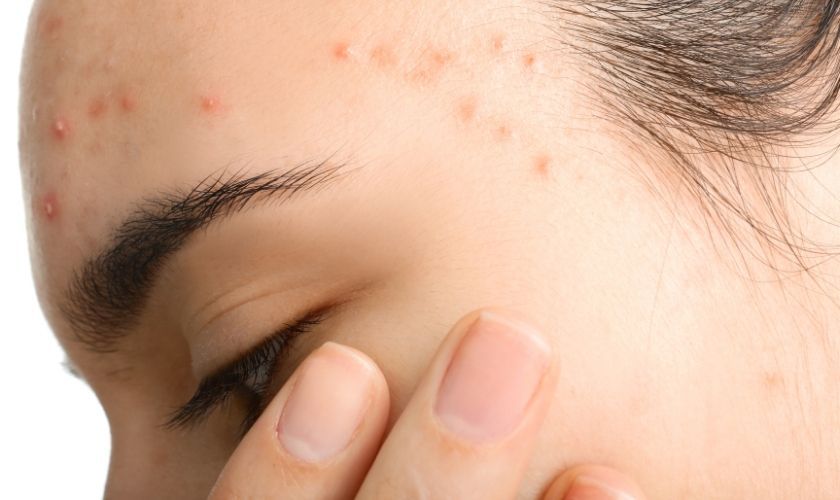 Isotretinoina a dosis bajas en el tratamiento del acné