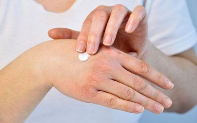 ¿Cómo se utilizan las cremas hidratantes en la dermatitis?