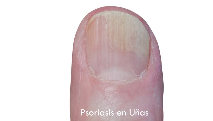 Psoriasis en uñas