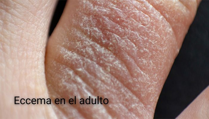 Foto dermatitis atopica adulto mano eccema dedo
