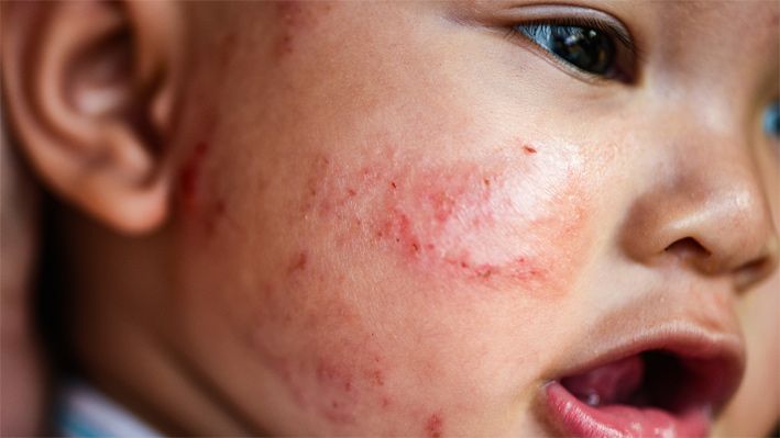 Fotos dermatitis atopica bebe por dermatologo especialista