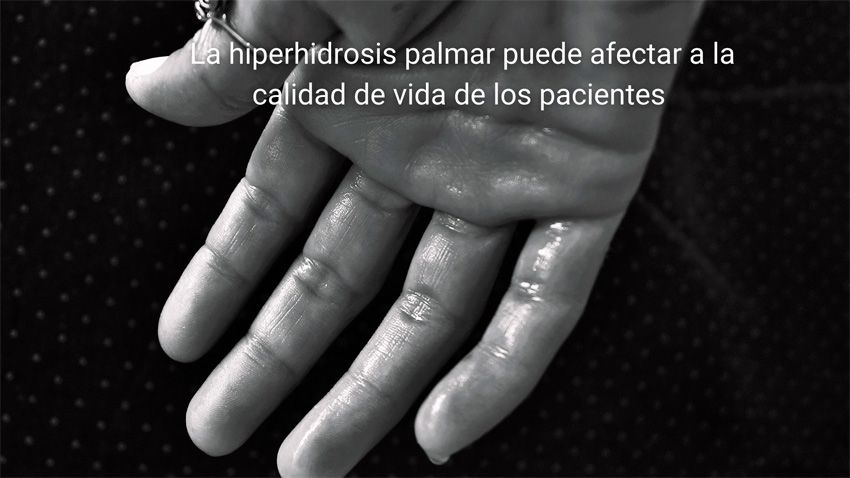 Hiperhidrosis palmar