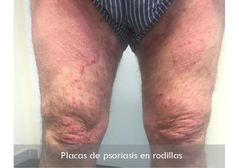 Psoriasis en rodillas