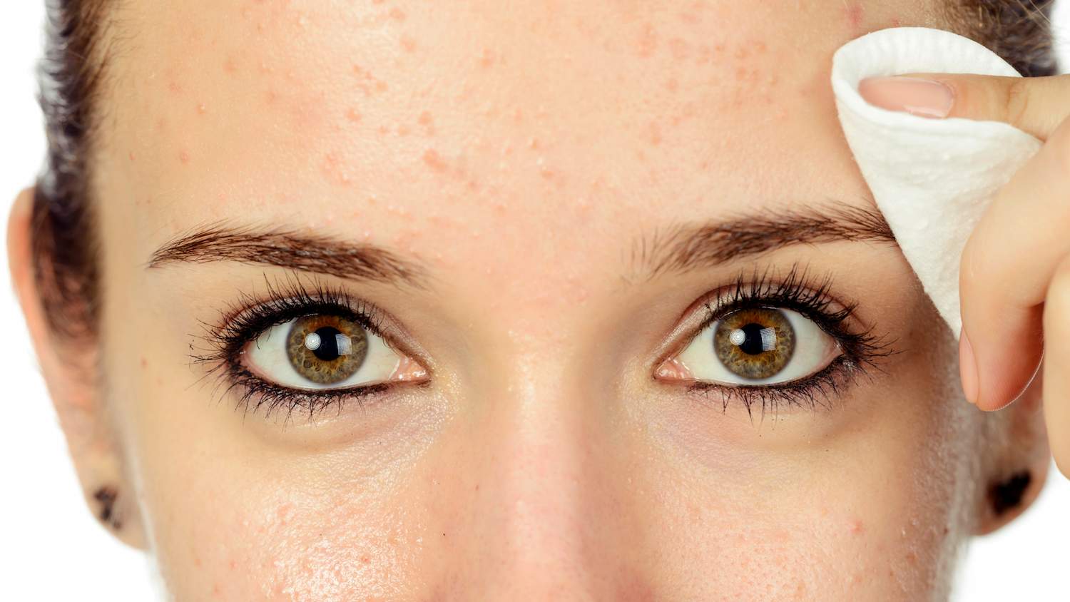 Cómo limpiarse la piel para cuidar el acné