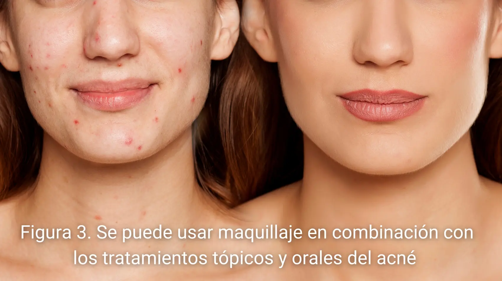 Maquillaje y tratamientos tópicos en el acné