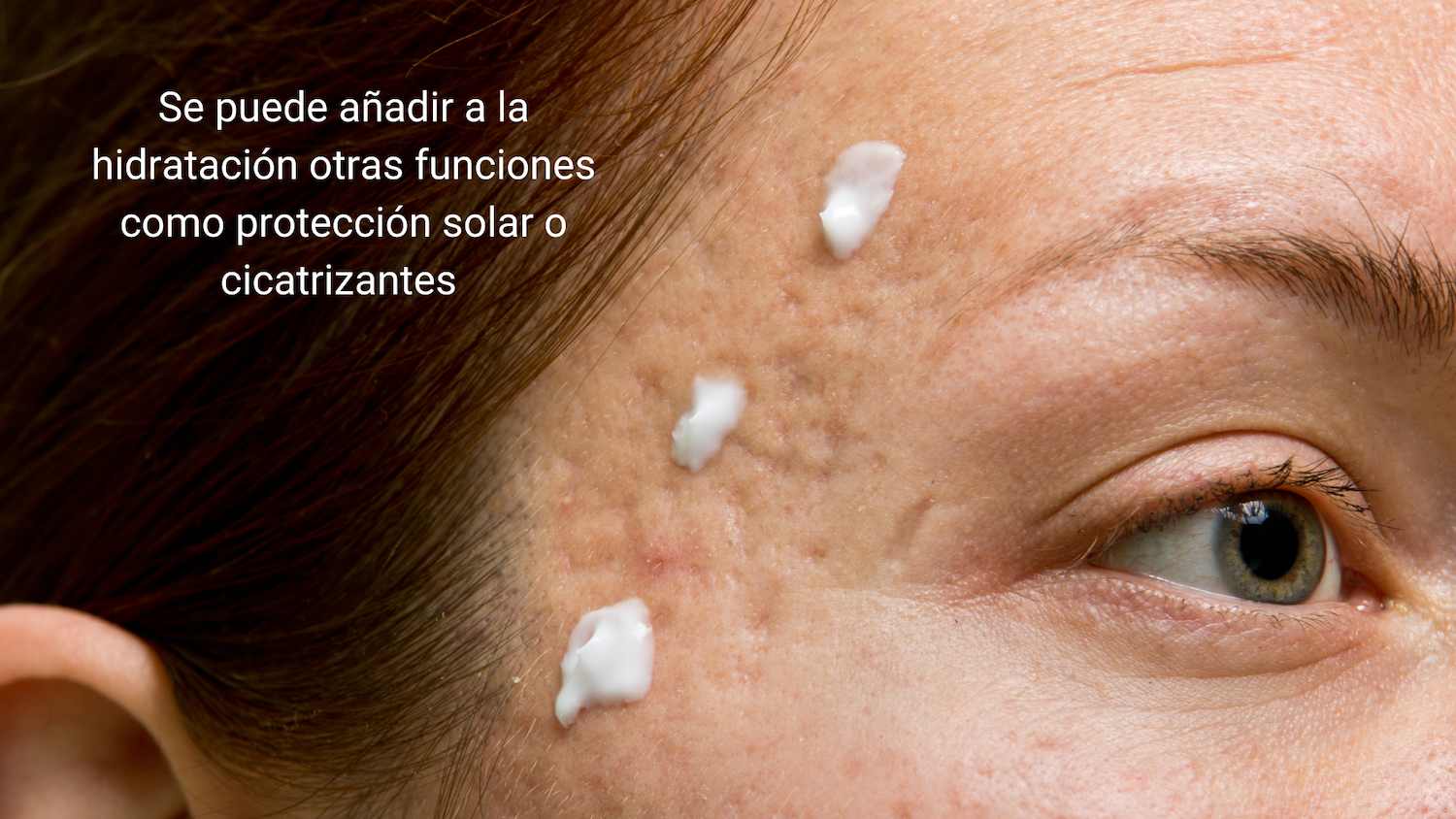 Hidratación de la piel con acné