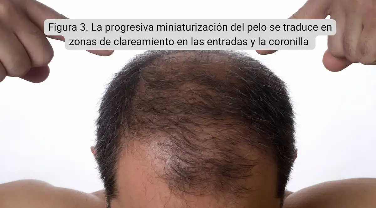Alopecia andrgenética, clareamiento en entradas y coronilla
