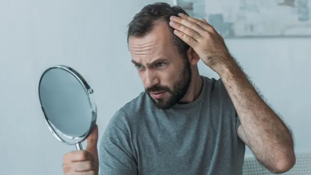 Alopecia masculina o alopecia androgenética