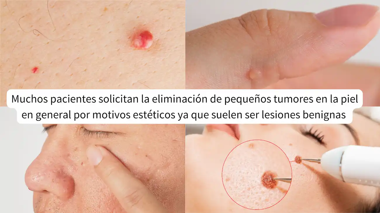 Eliminación de pequeños tumores de la piel