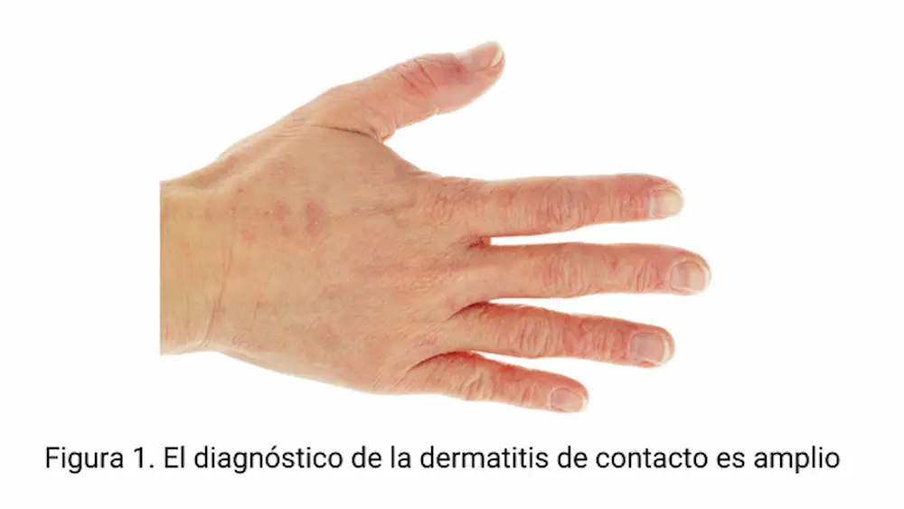 Diagnóstico de la dermatirtis de contacto