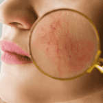 Rostro de paaciente femenina muestra ignos de rosácea