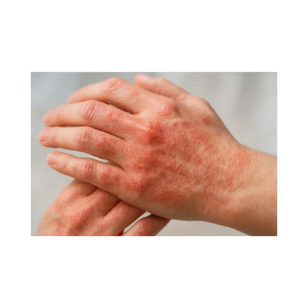 Eccema dishidrotico eccema de manos