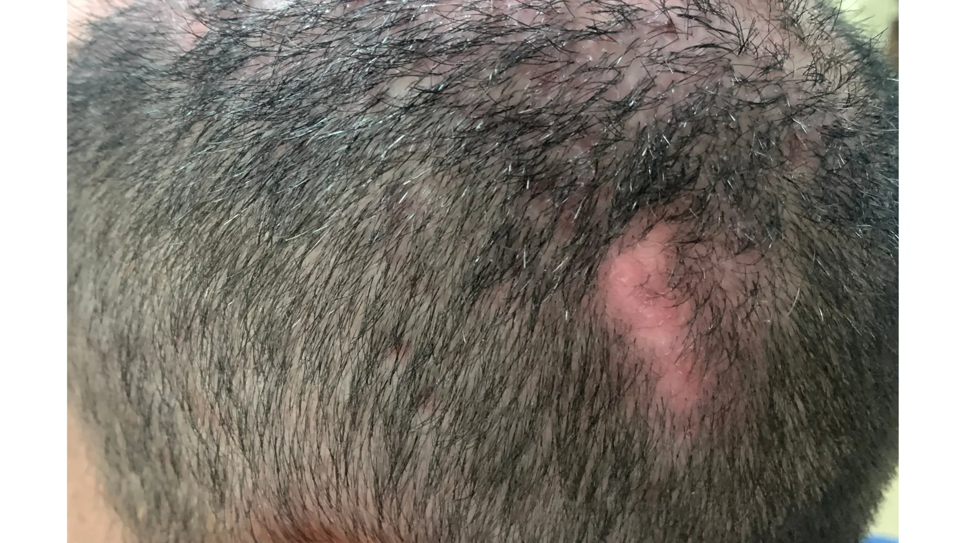 Alopecia cicatricial dermatologo