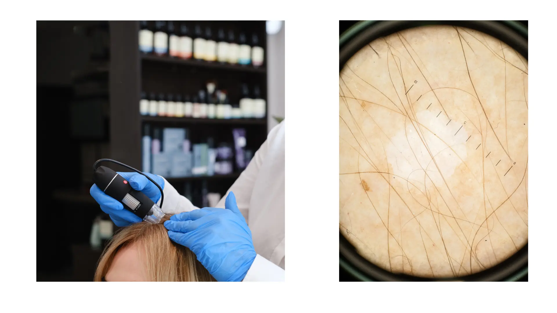 Tricoscopia del cuero cabelludo por dermatologo