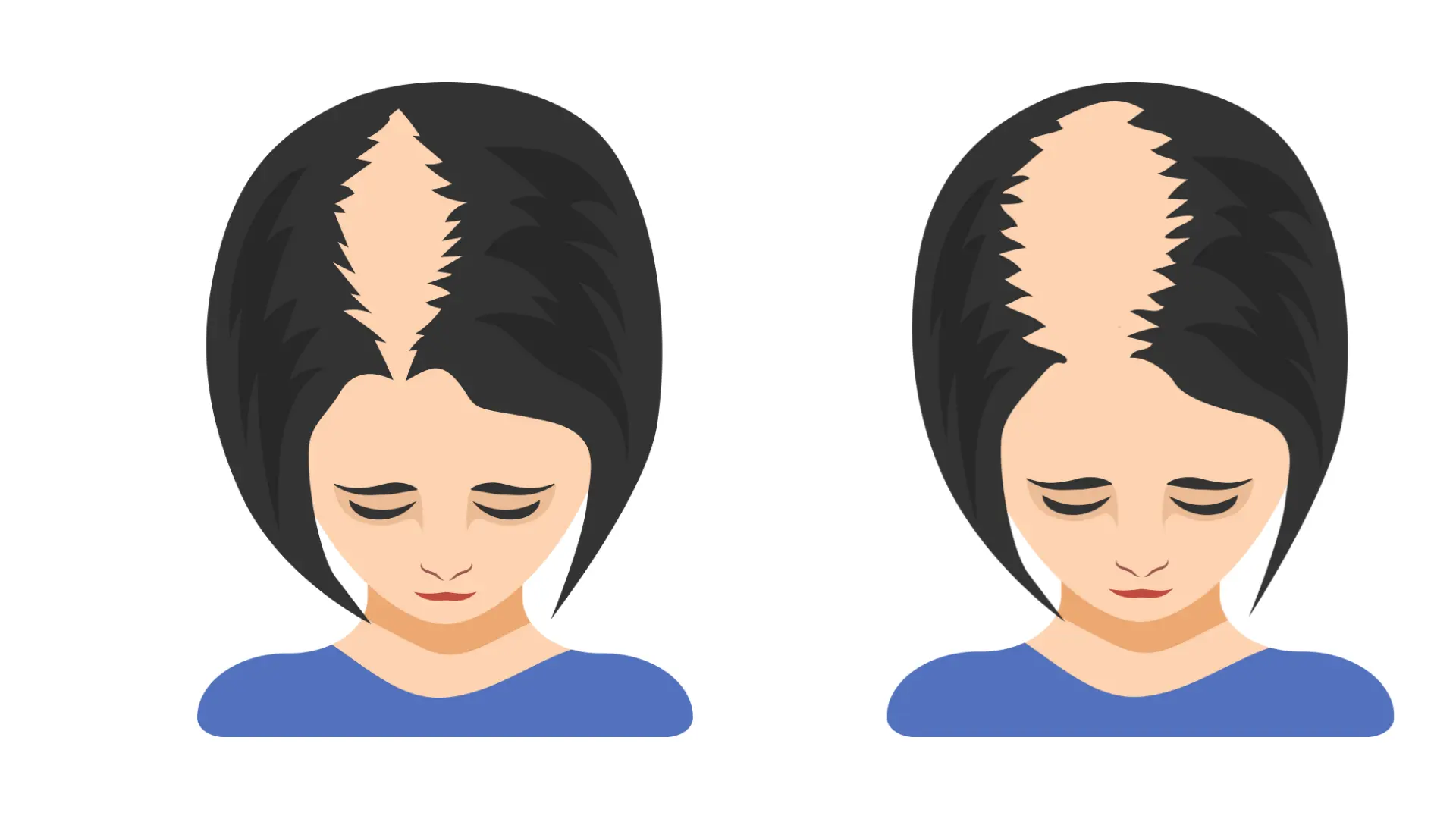 Alopecia en la mujer