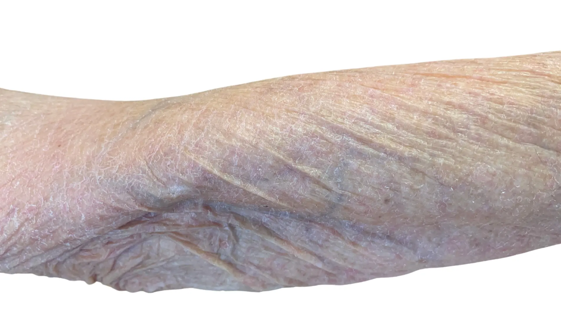 Imagen de un anciano con un eccema seco por dermatologo