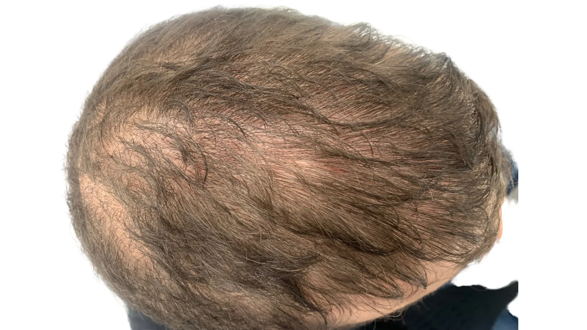 Alopecia areata en repoblacion