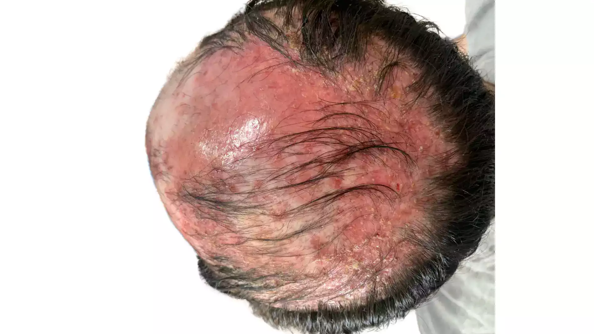 Alopecia por el sol