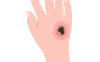 Categoría Consejos Del Dermatólogo 1 Las 5 causas de cuerno cutáneo por un dermatólogo