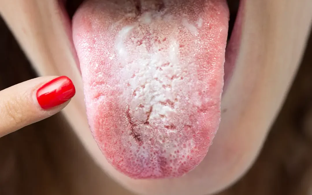 Micosis cutanea candidiasis