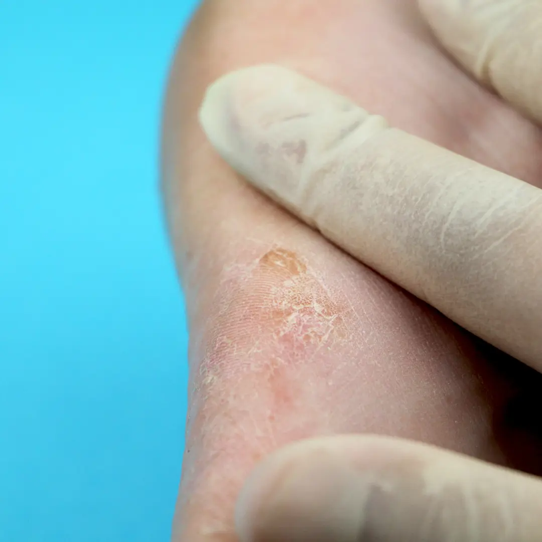 Micosis cutanea pie de atleta