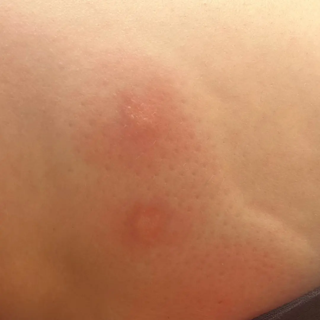 Alergia a picadura de mosquito