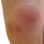 Alergia a picaduras de mosquito por dermatologa