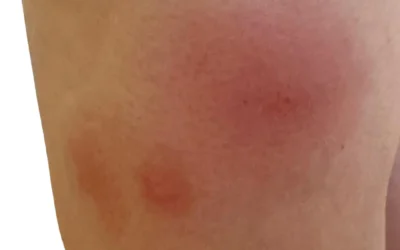 ¿existe la alergia a picaduras de mosquito? Mi experiencia como dermatóloga