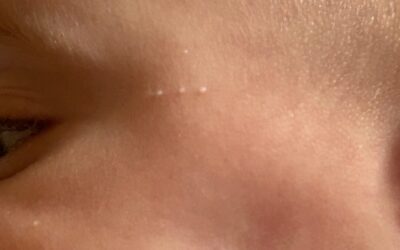 Por qué salen los quistes de millium y como los trato