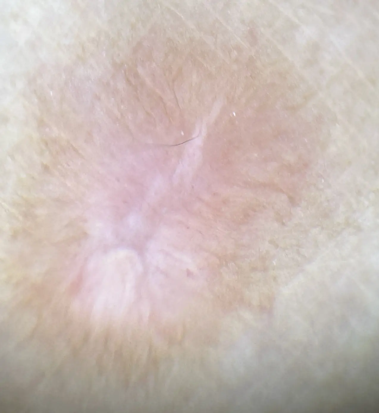 Dermatofibroma dermatoscopia