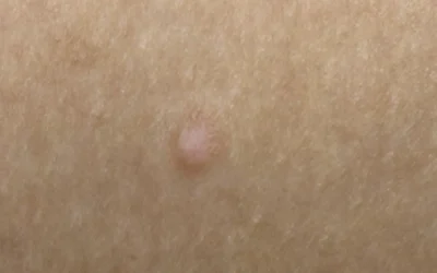 ¿qué es un dermatofibroma y cómo se trata? Por dermatólogo