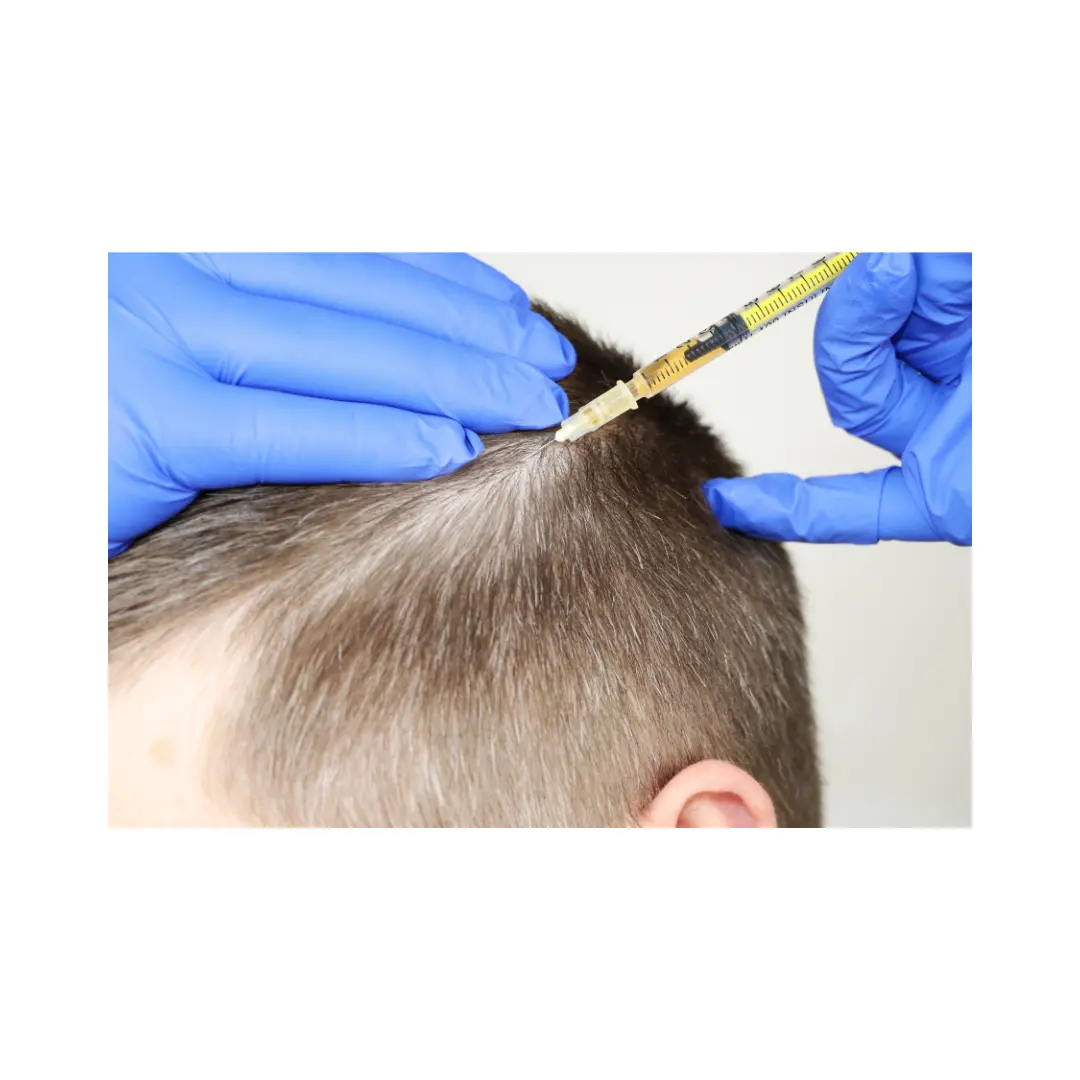 Mesoterapia capilar por dermatologo