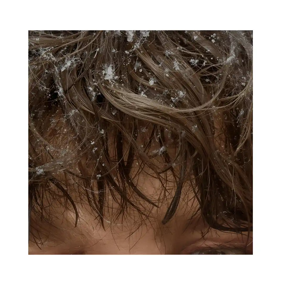 Remedios caseros para la caspa