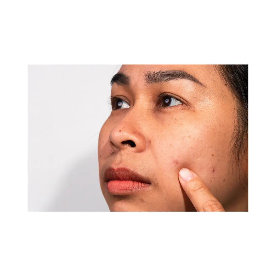 Mancha en la cara cuando consultar al dermatologo