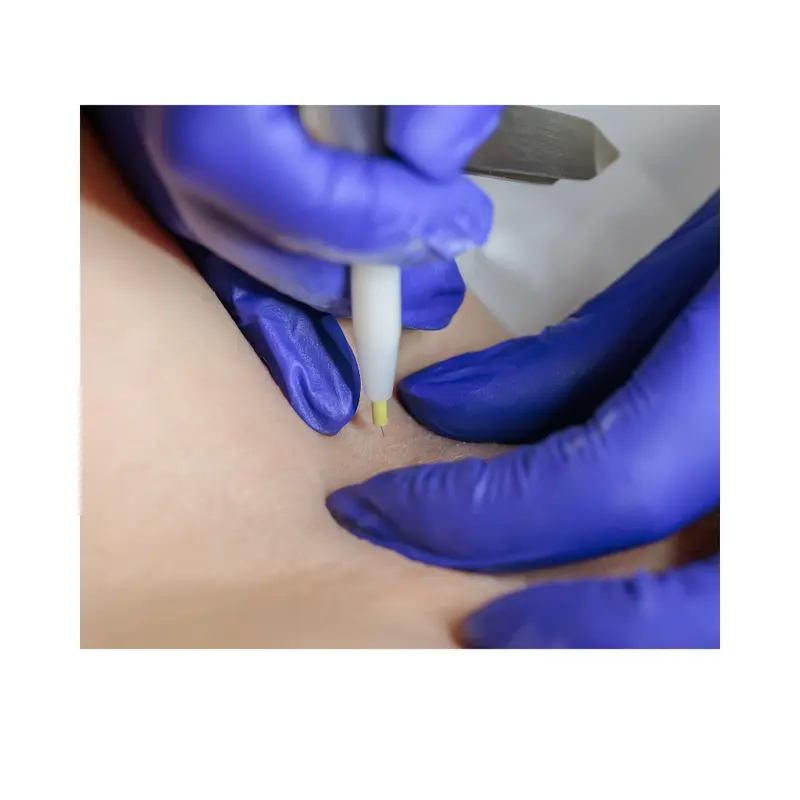 Depilacion electrica dermatologo complicaciones