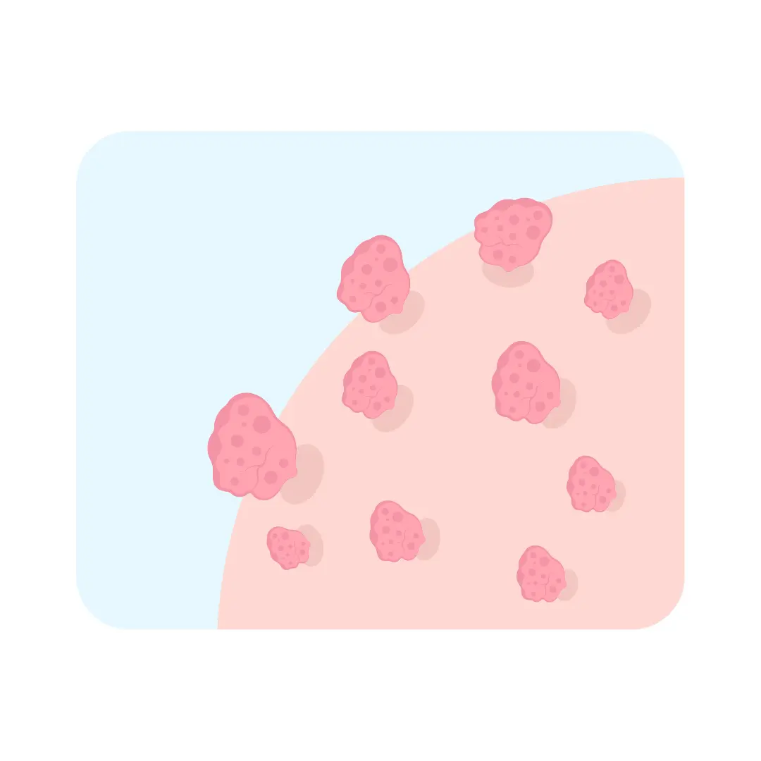 Verrugas genitales clinica