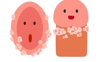 7 puntos para entender las verrugas genitales