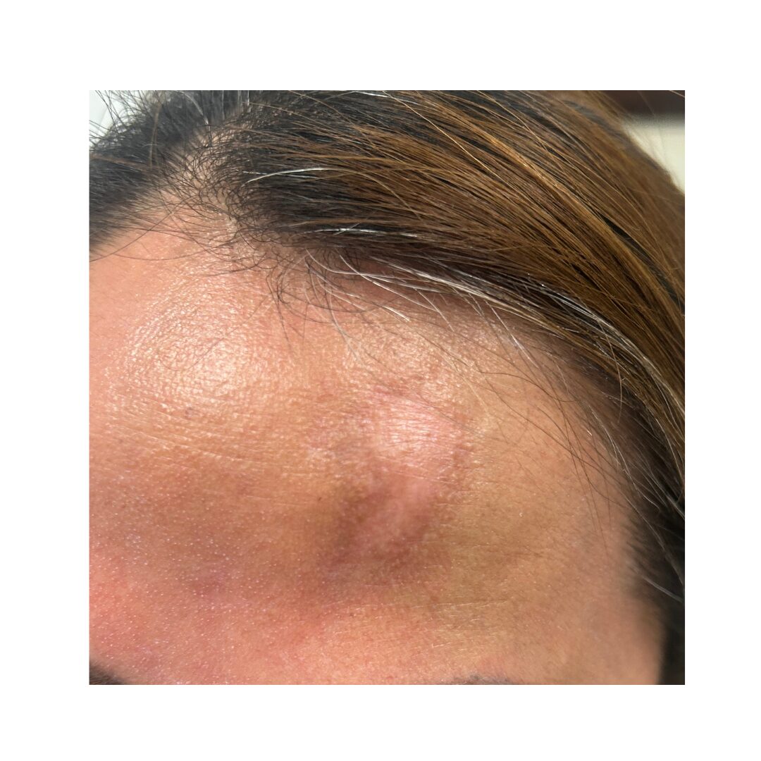 Especialistas En Eliminación De Manchas Faciales En Madrid 3 Eliminar-manchas-en-cara-hiperpigmentacion-postinflamatoria