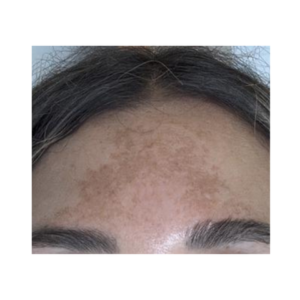 Especialistas En Eliminación De Manchas Faciales En Madrid 1 Eliminar-manchas-en-cara-melasma