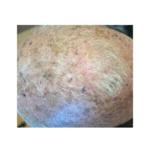 Especialistas En Eliminación De Manchas Faciales En Madrid 4 Eliminar-manchas-en-cara-queratosis-actinica