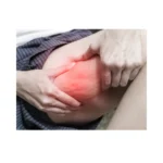 Lipedema por dermatologo